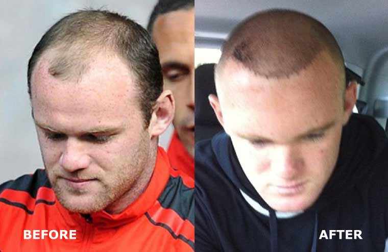 Who Is Suitable For Hair Transplant Surgery Fashion Beauty Health