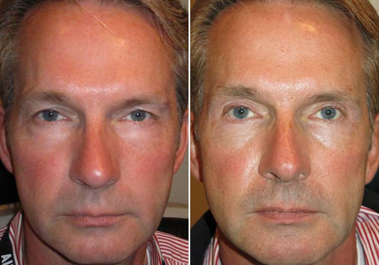 Cosmetic Surgery Trends – Beards & Blepharoplasty